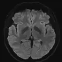 bigwrinklybrain emote for Discord